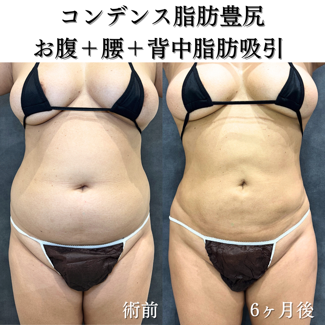 コンデンス脂肪豊尻、お腹+腰+背中脂肪吸引の症例です💁