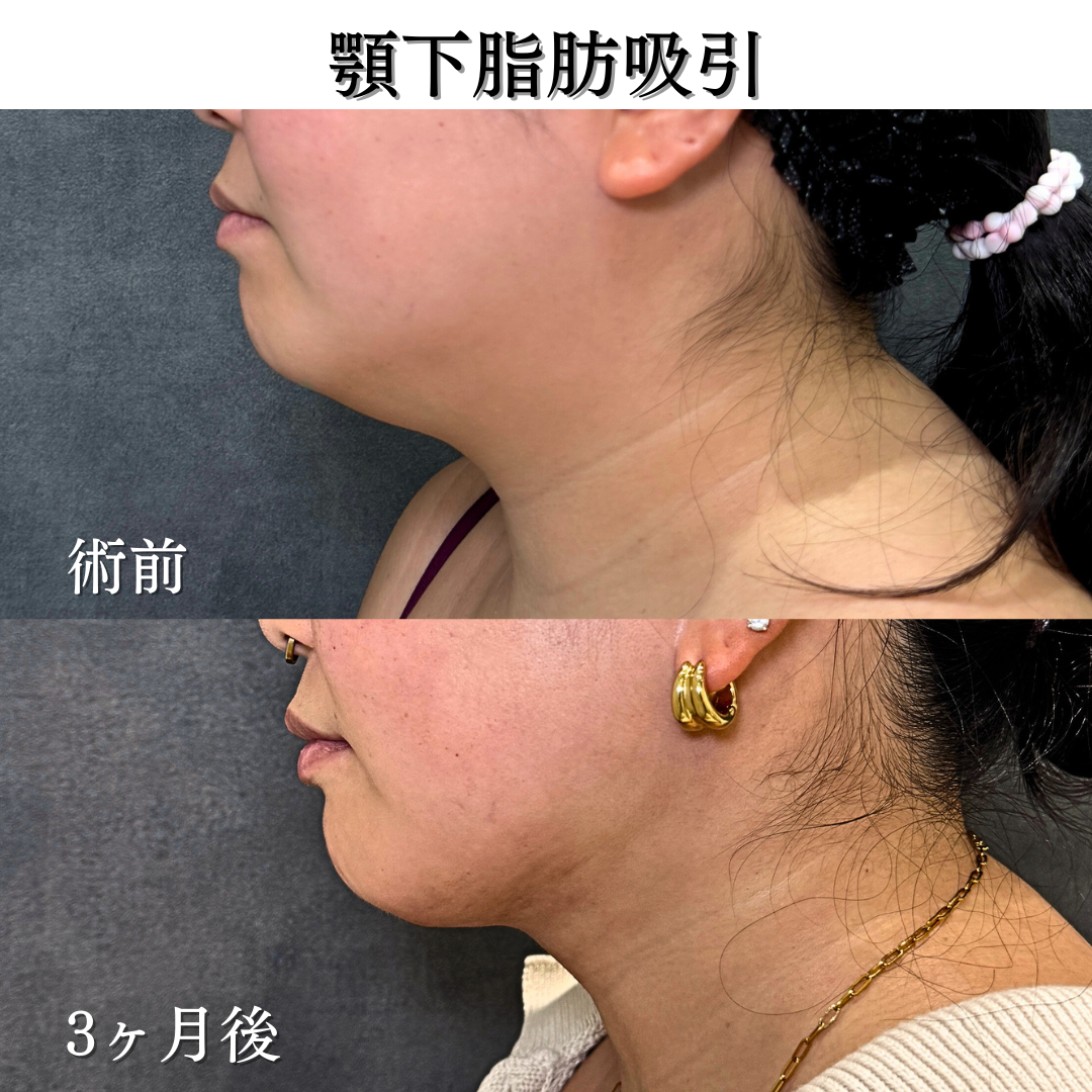 顎下脂肪吸引の症例です💁