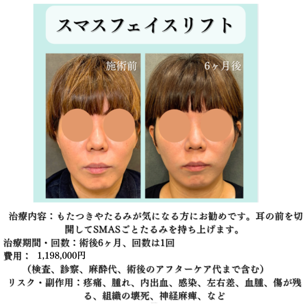 SMASフェイスリフトの症例です💁