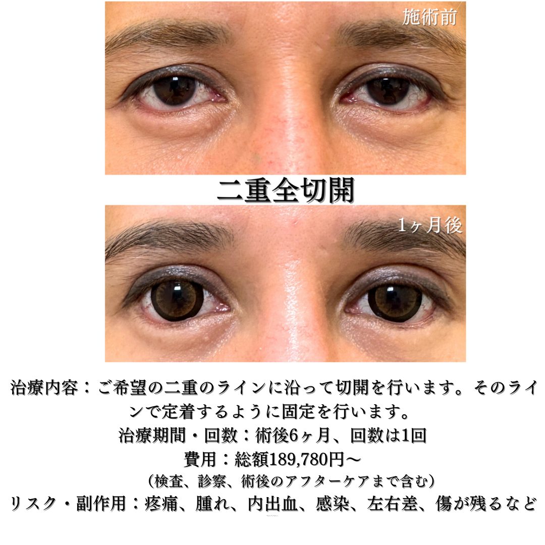二重全切開の症例です💁‍♀️