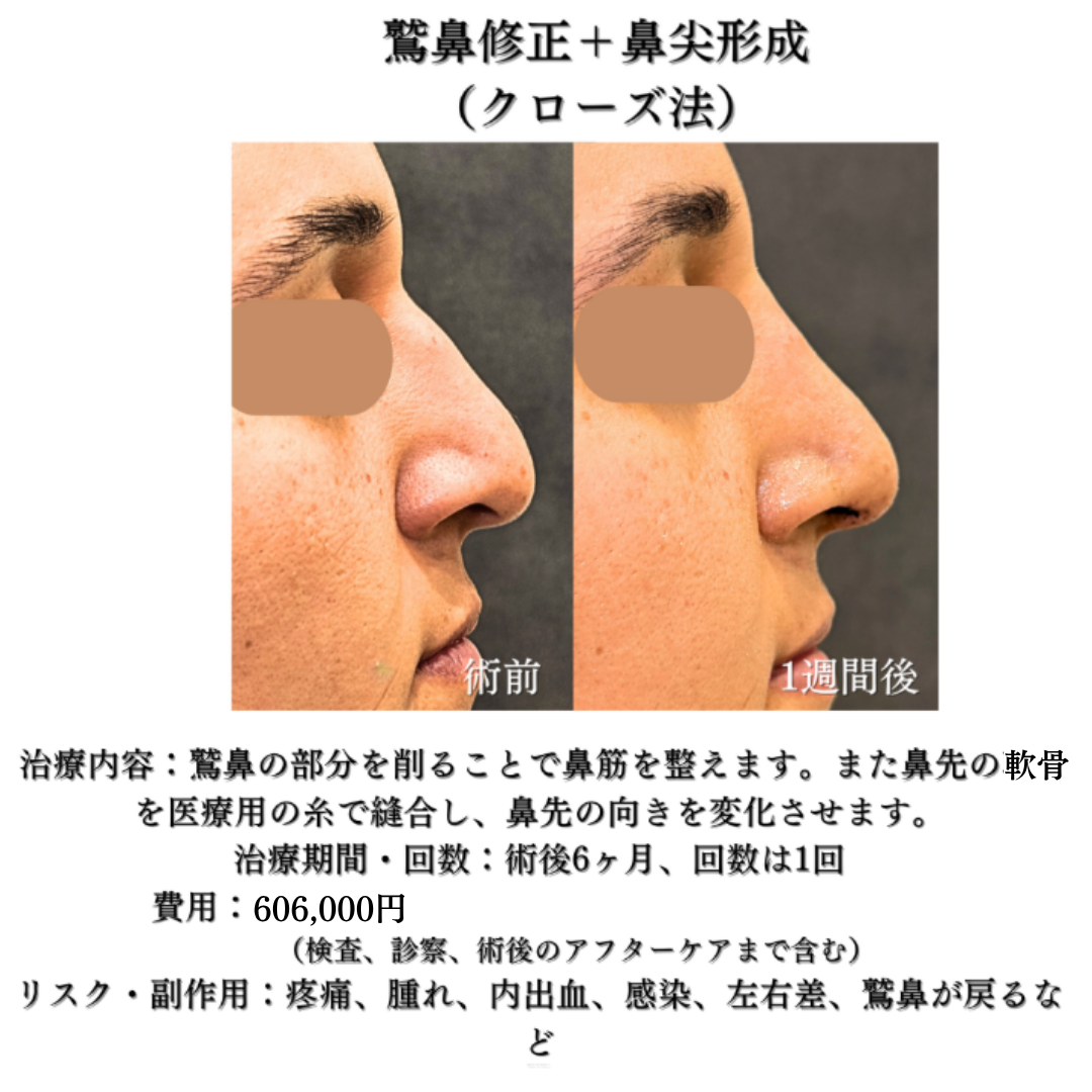 わし鼻修正+鼻尖形成クローズ法の症例です💁