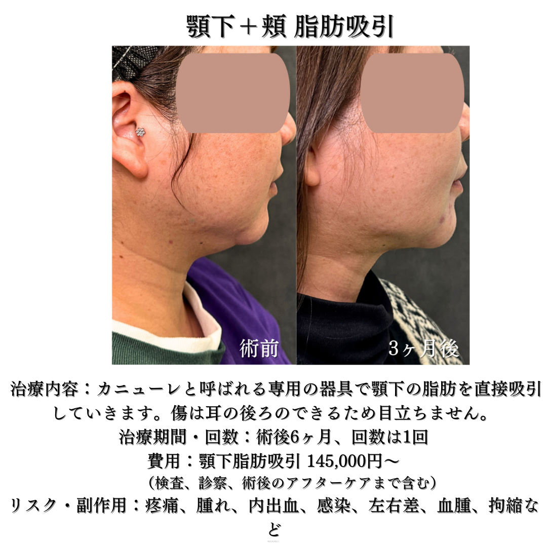 顎下脂肪吸引の症例です💁