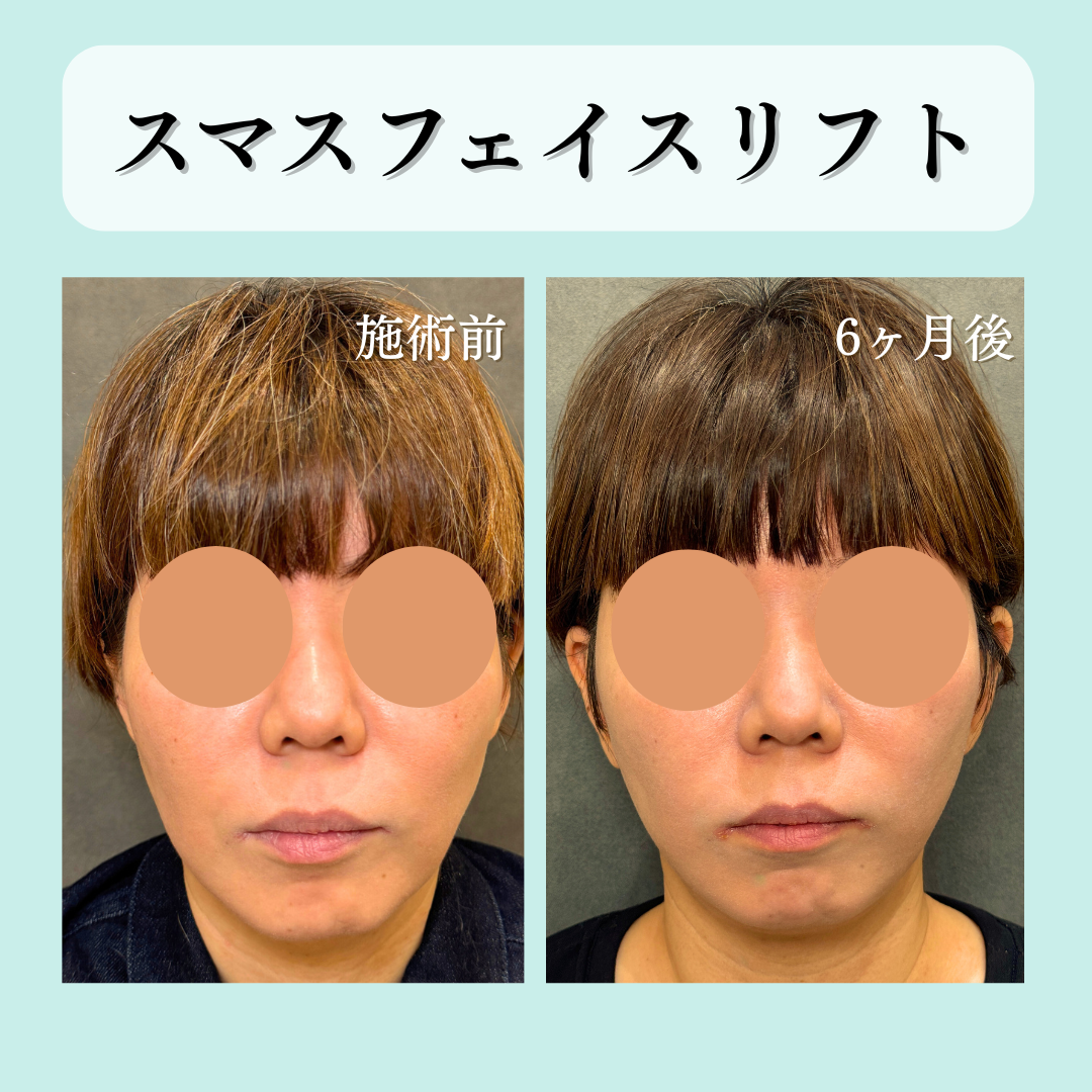 SMASフェイスリフトの症例です💁