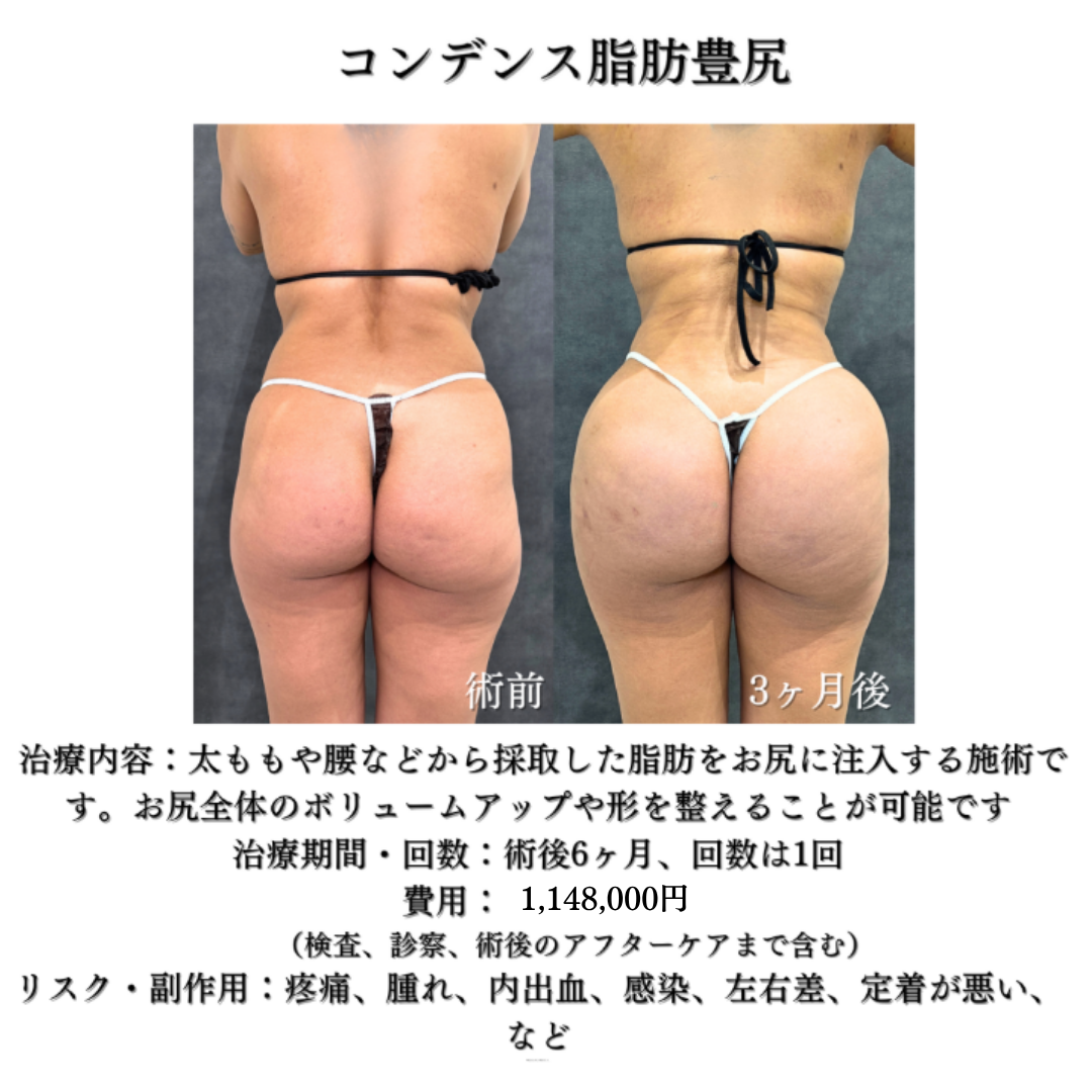 コンデンス脂肪豊尻（BBL）の症例です💡