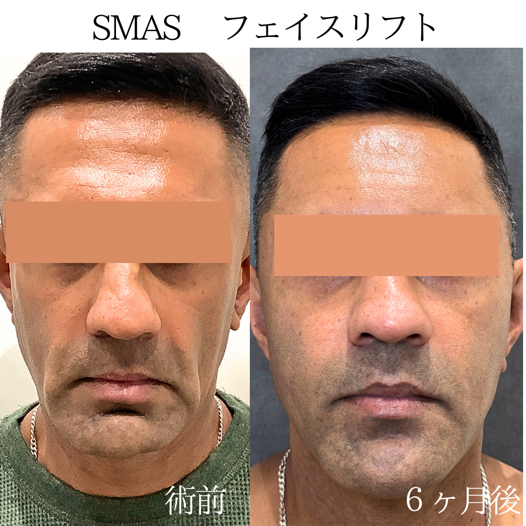 フェイスリフトの6ヶ月症例です👑