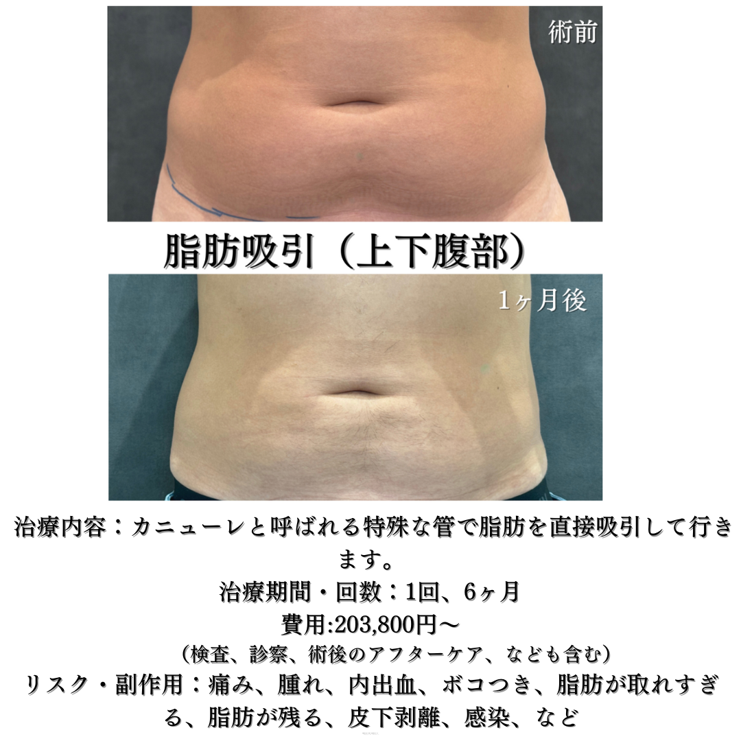 腹部脂肪吸引の症例です✨