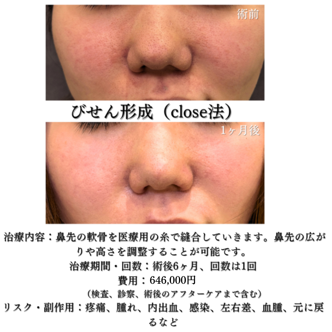 びせん形成close法＋鼻孔縁挙上の症例です💁‍♀️