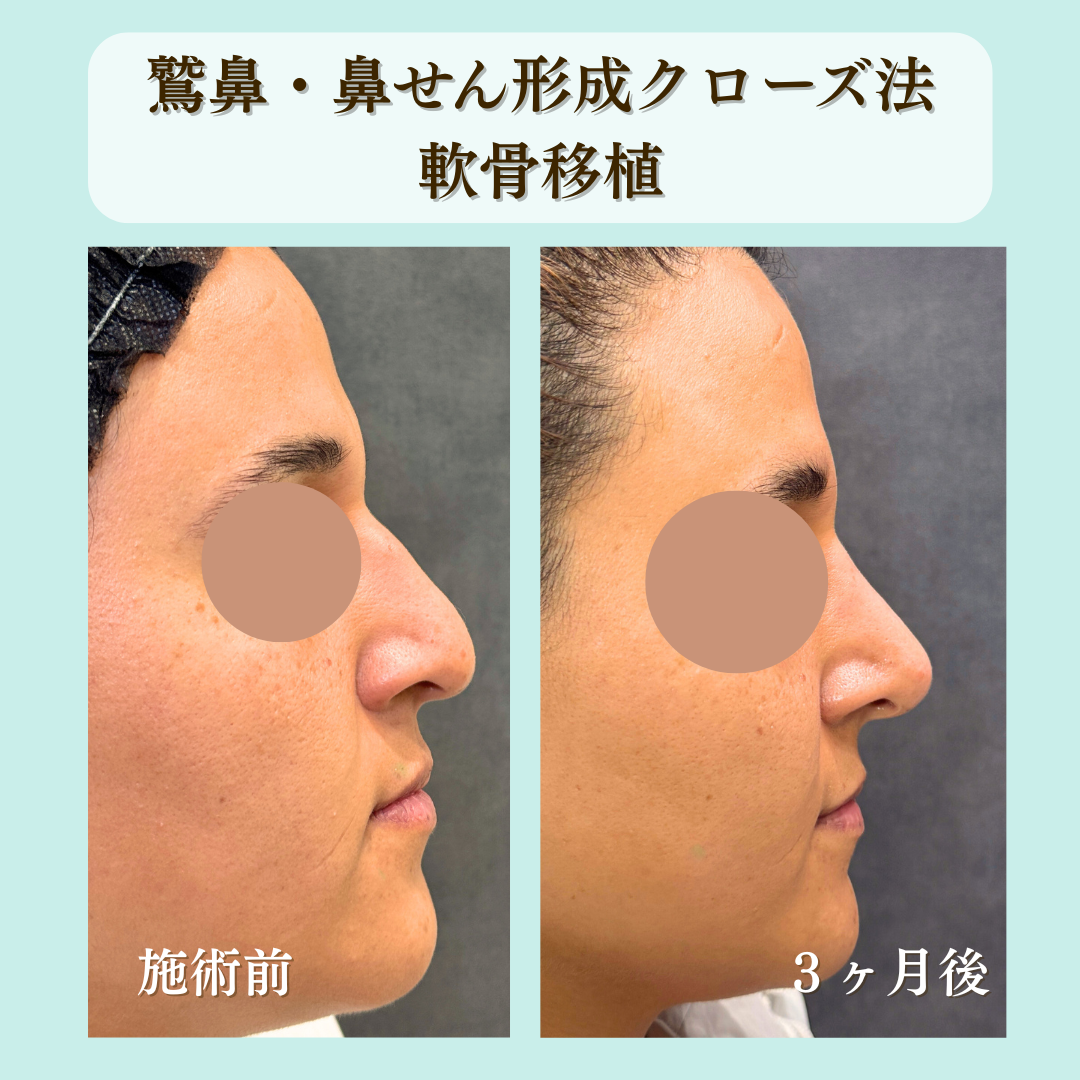 わし鼻とびせん形成クローズ法＋軟骨移植の症例です💁