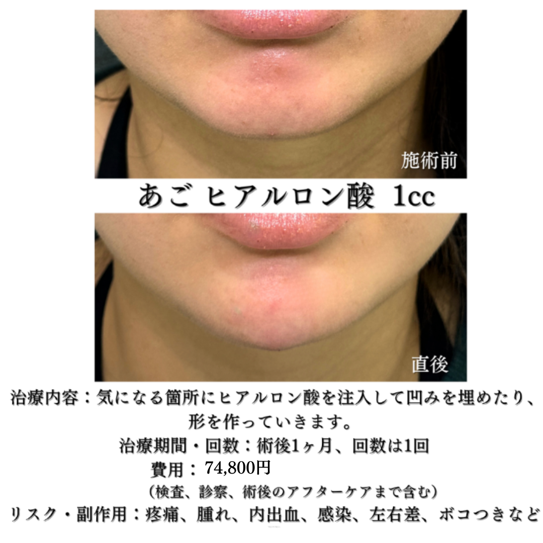 あごのヒアルロン酸の症例です💡