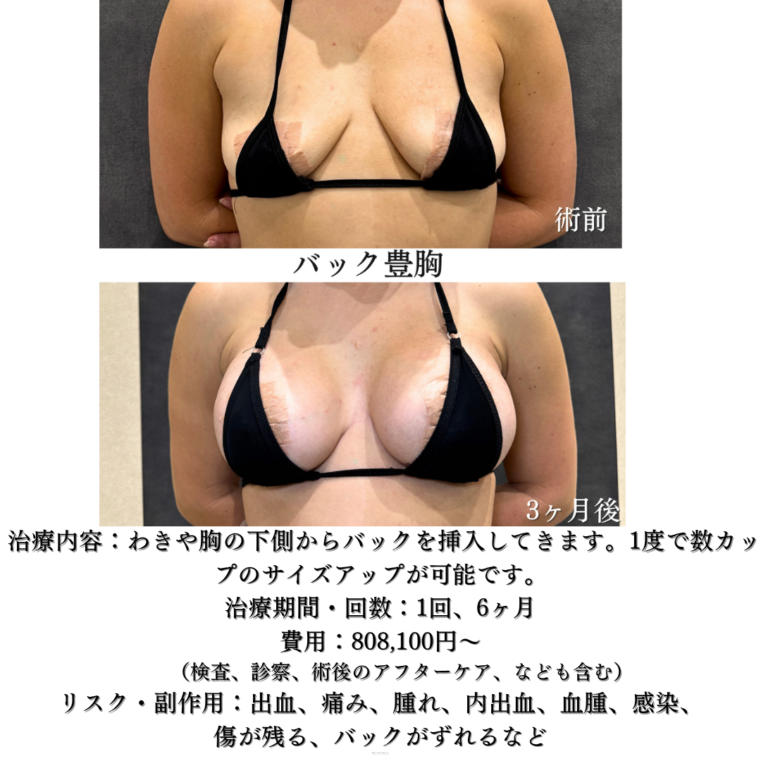バック豊胸の方です💁