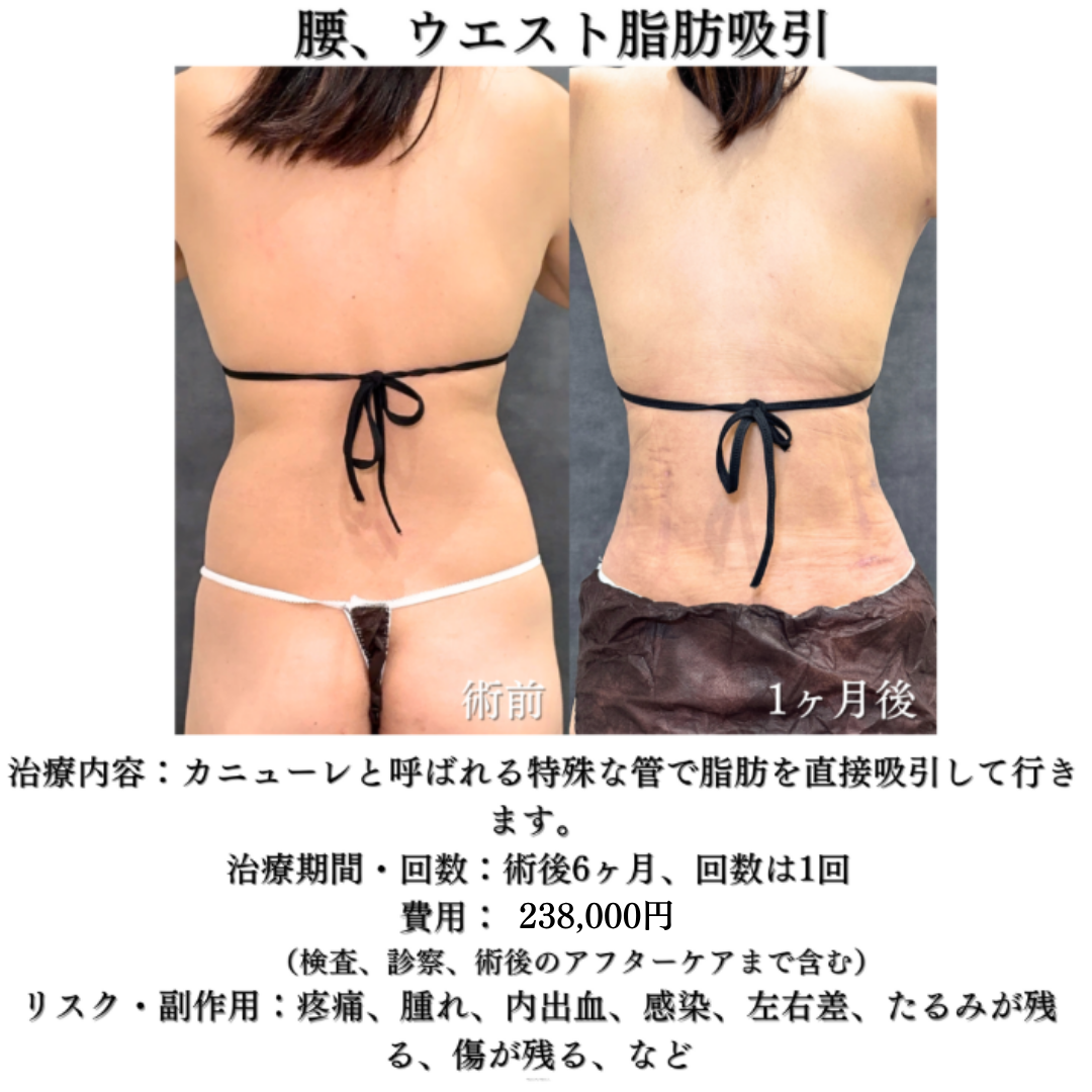 腰＋ウエストの脂肪吸引の症例です💁‍♀️
