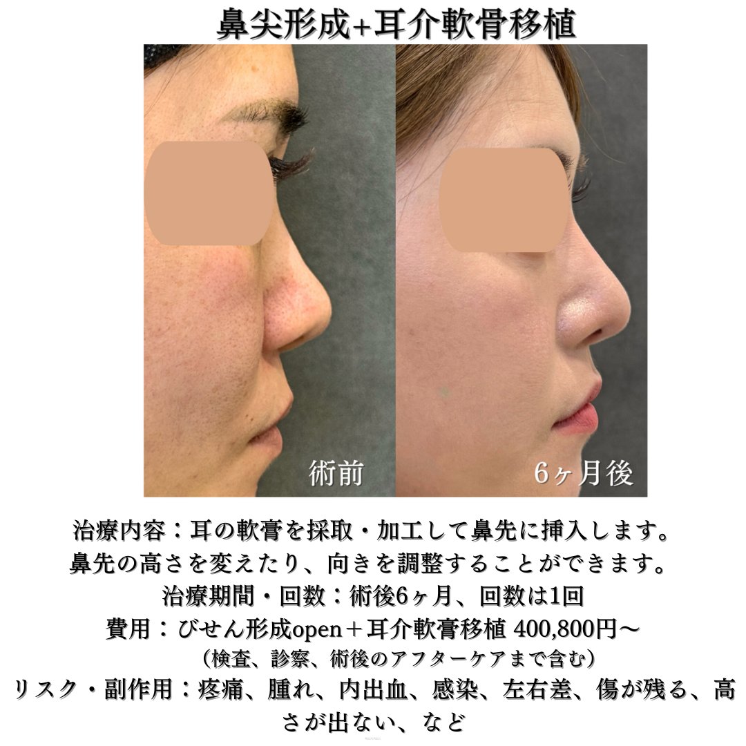 鼻尖形成＋耳介軟骨移植＋プロテーゼの症例です💁‍♀️