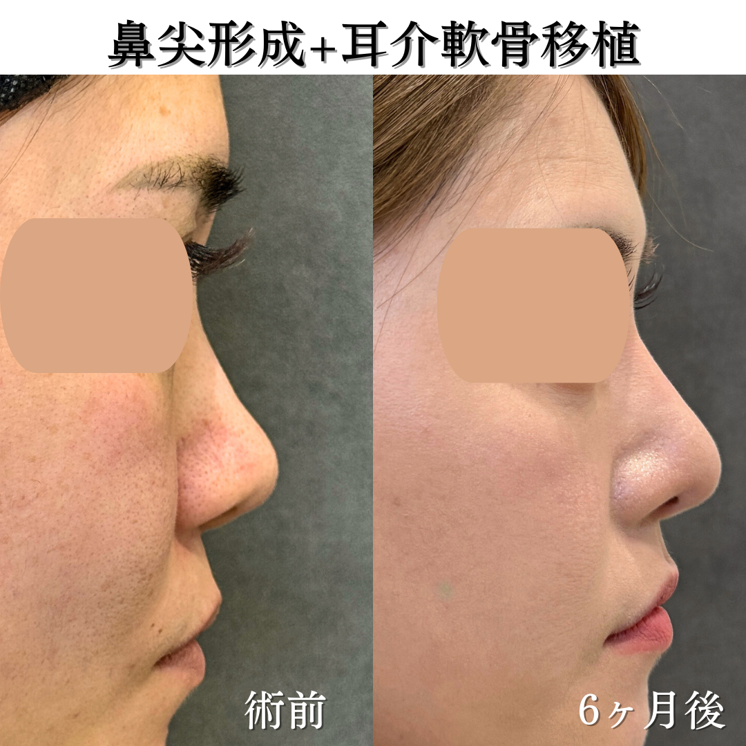 鼻尖形成＋耳介軟骨移植＋プロテーゼの症例です💁‍♀️