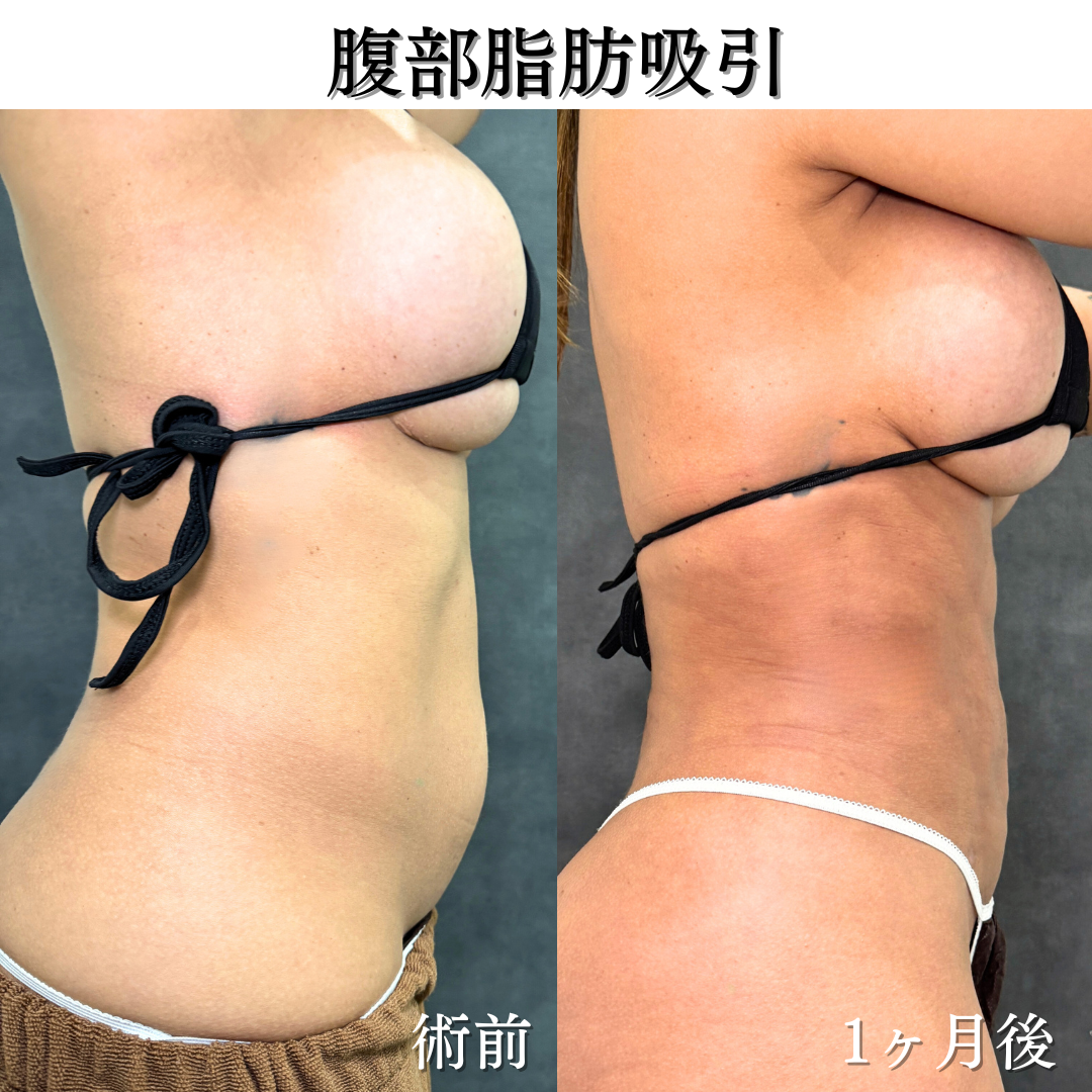 腹部脂肪吸引の症例です💁♀️