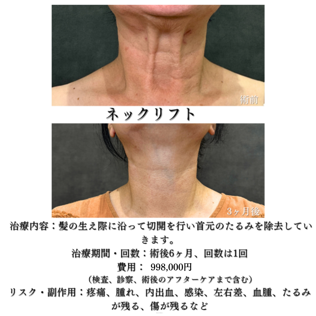 ネックリフトの症例です✨
