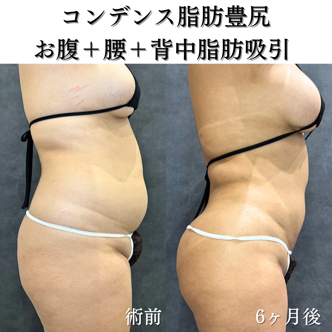 コンデンス脂肪豊尻、お腹+腰+背中脂肪吸引の症例です💁