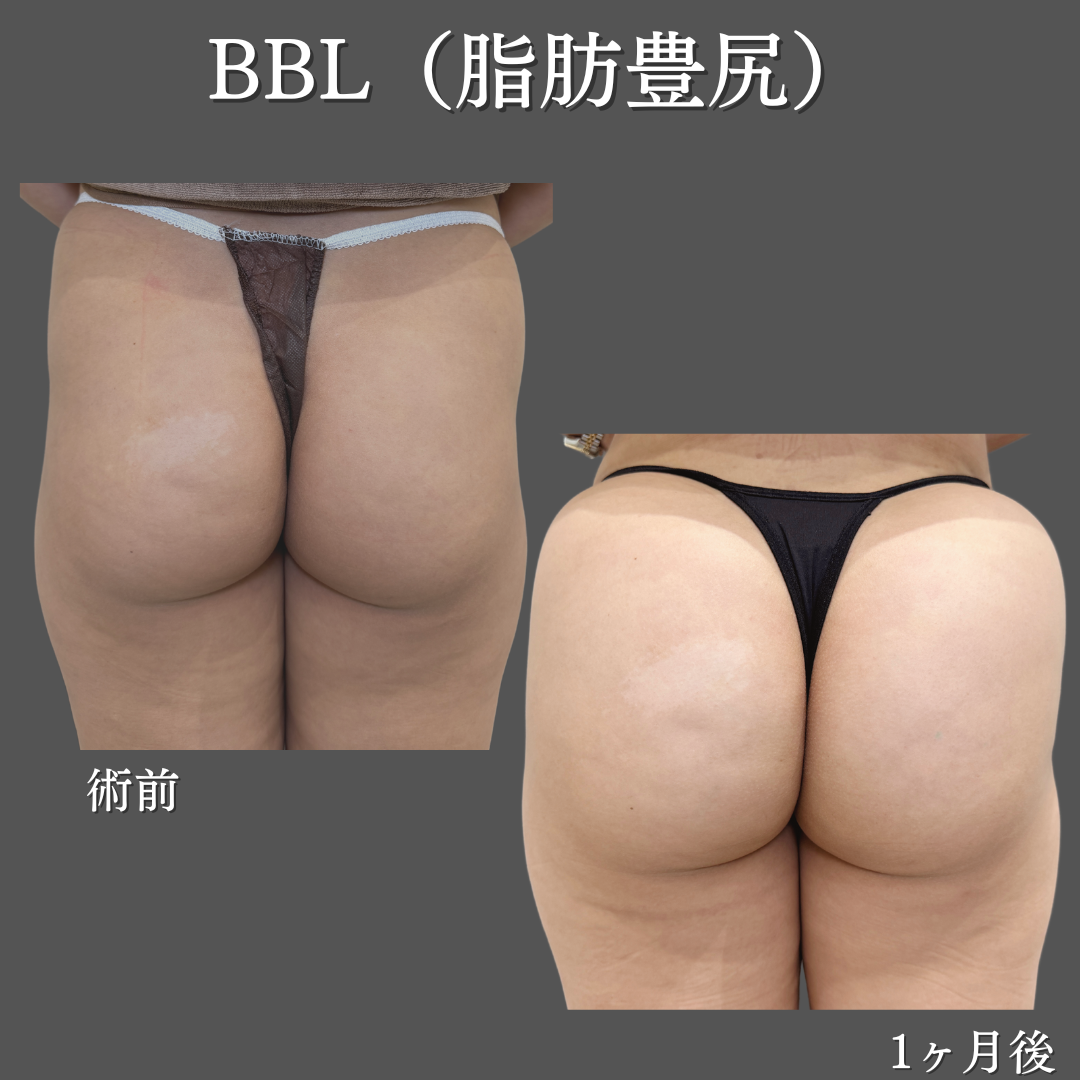 コンデンス脂肪豊尻（BBL）の症例です💁‍♀️