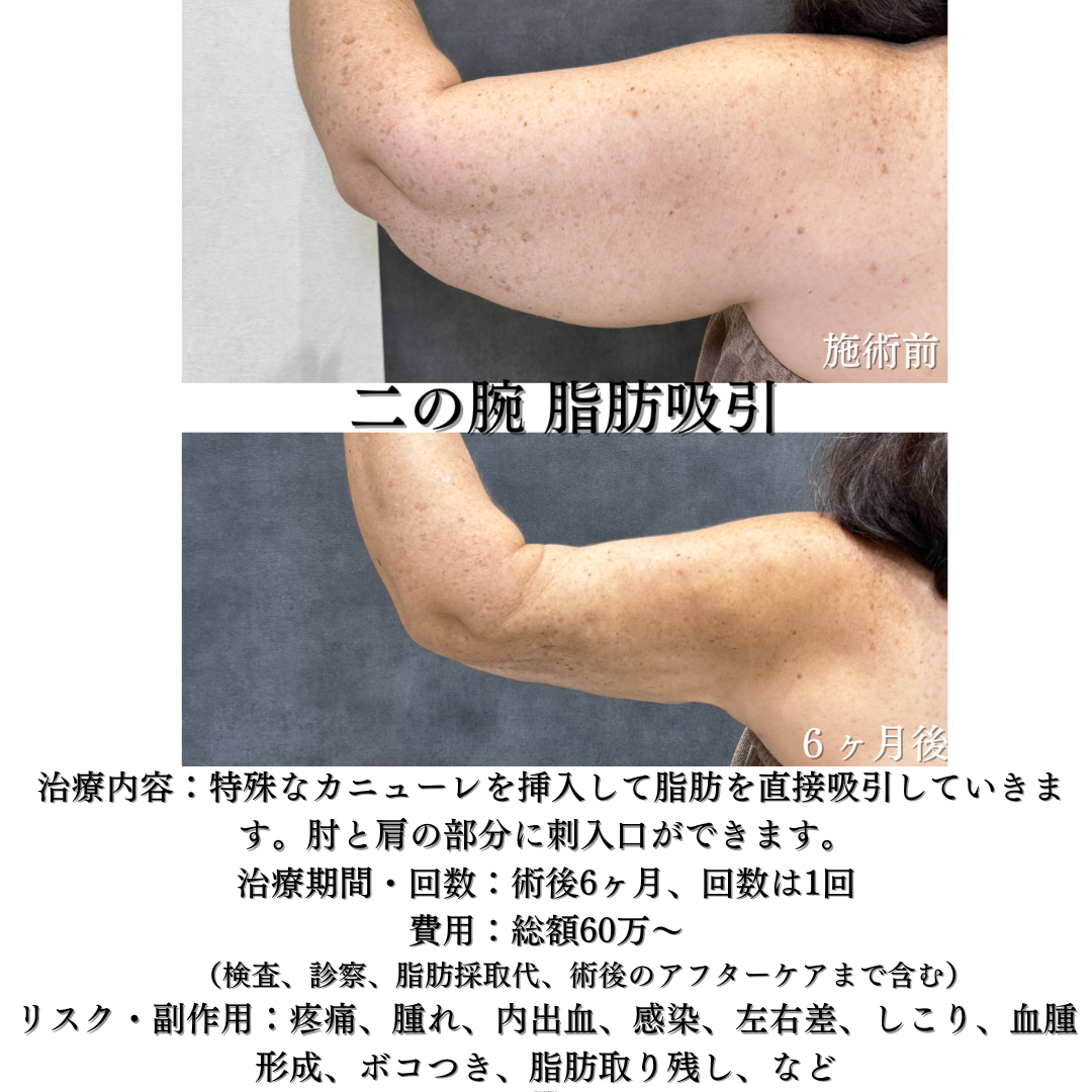 二の腕、肩、の脂肪吸引の症例です💡