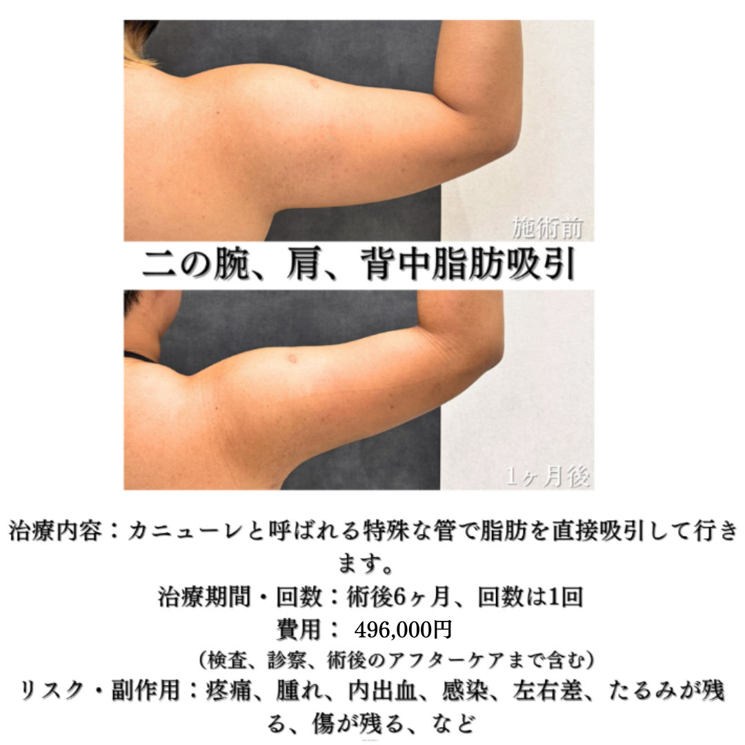 二の腕、肩、背中の脂肪吸引の症例です💡