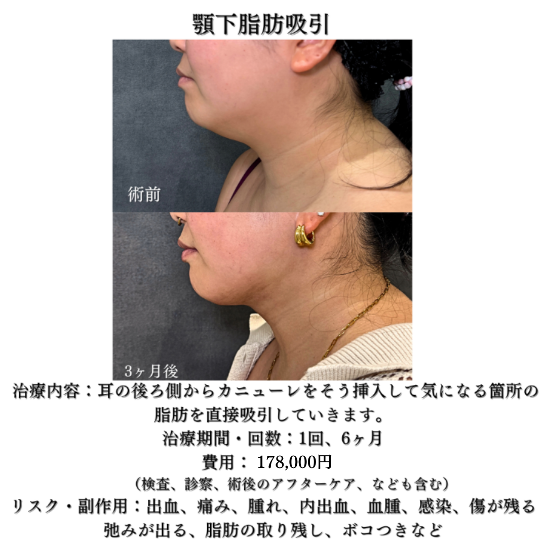 顎下脂肪吸引の症例です💁