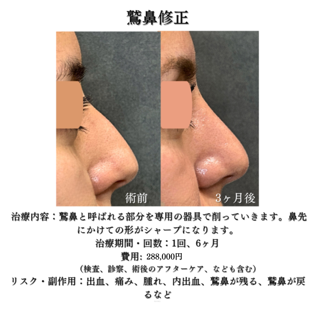 わし鼻修正の症例です💁