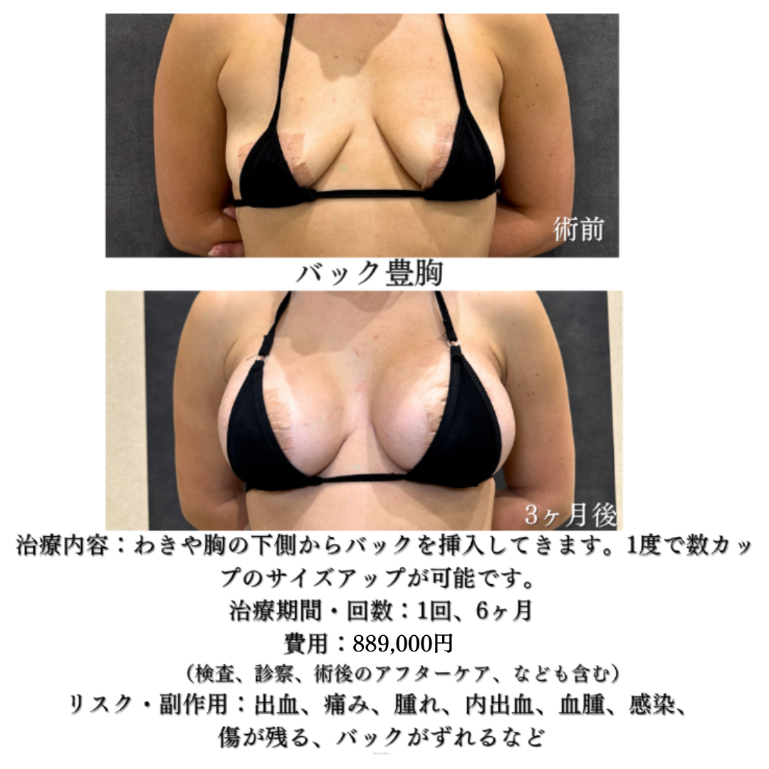 バック豊胸の方です💁