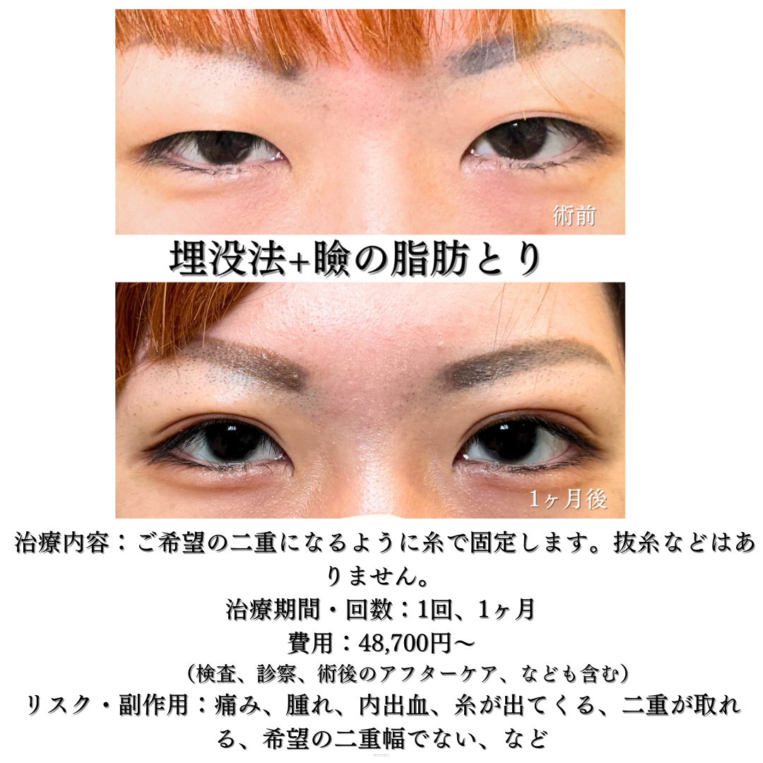二重埋没法+瞼の脂肪+他院埋没糸抜糸とりを行った症例です💁‍♀️