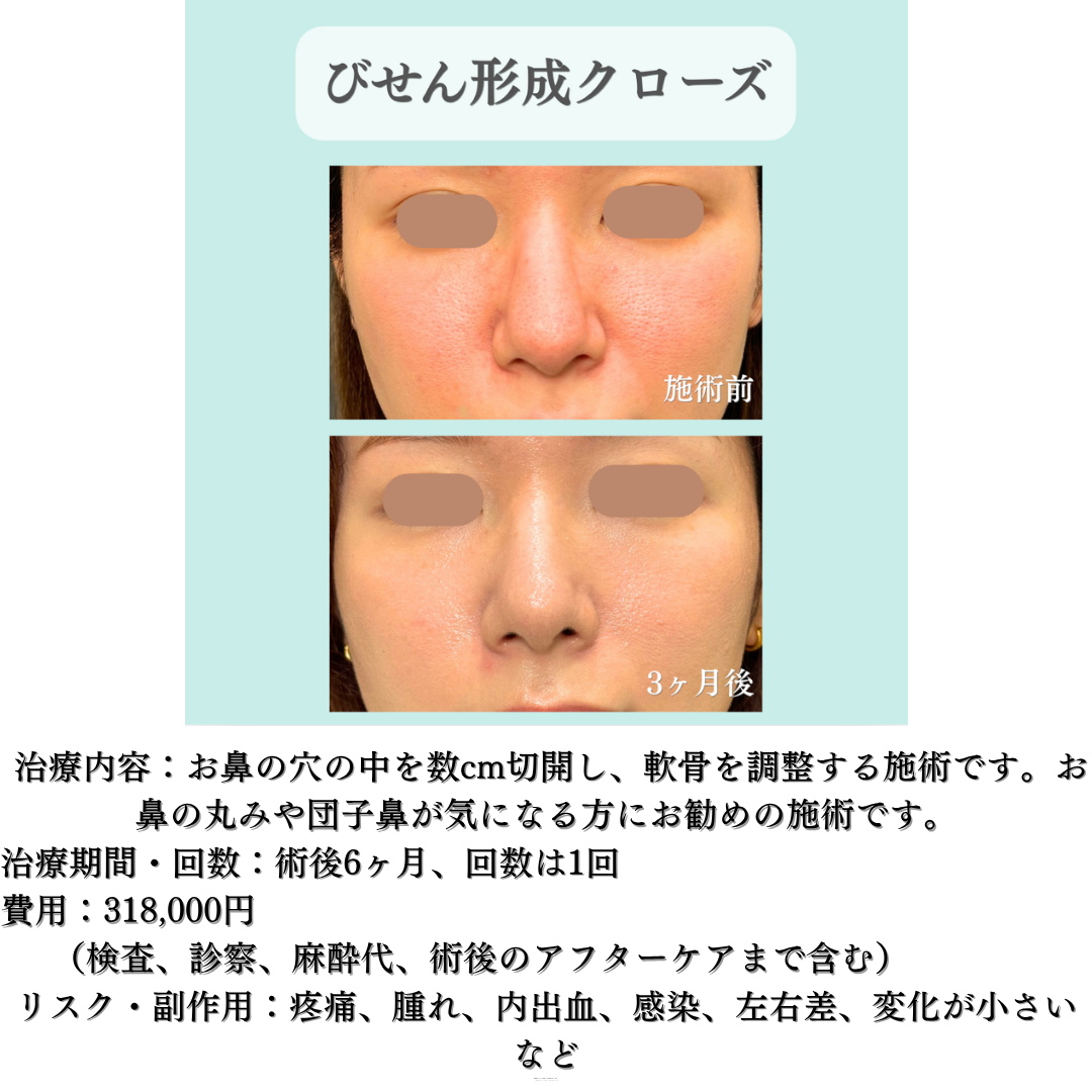 鼻尖形成クローズ法の症例です💁