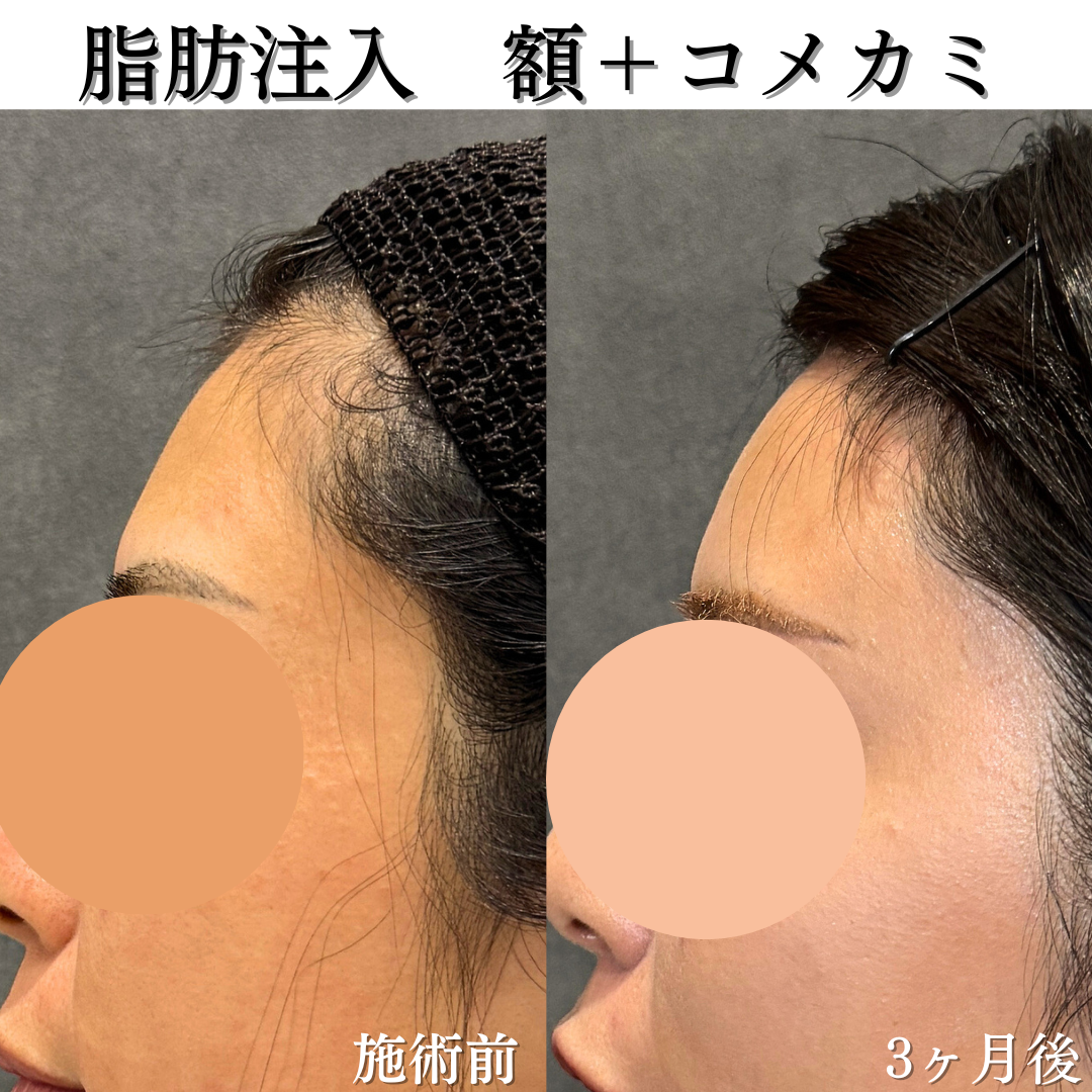 額、こめかみ、法令線の脂肪注入の症例です💁