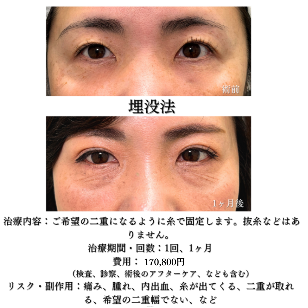 二重埋没法5点どめの症例です💡