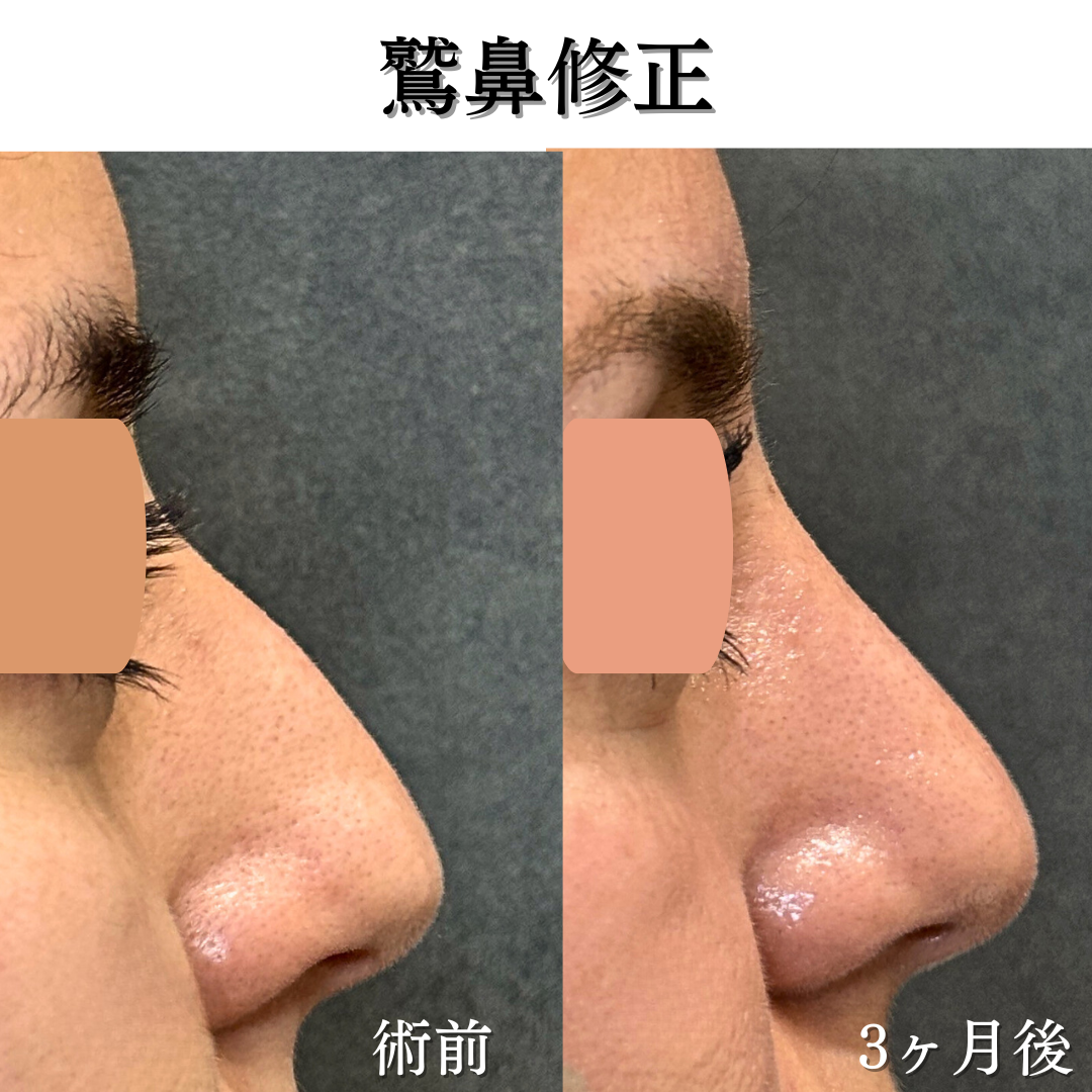 わし鼻修正の症例です💁