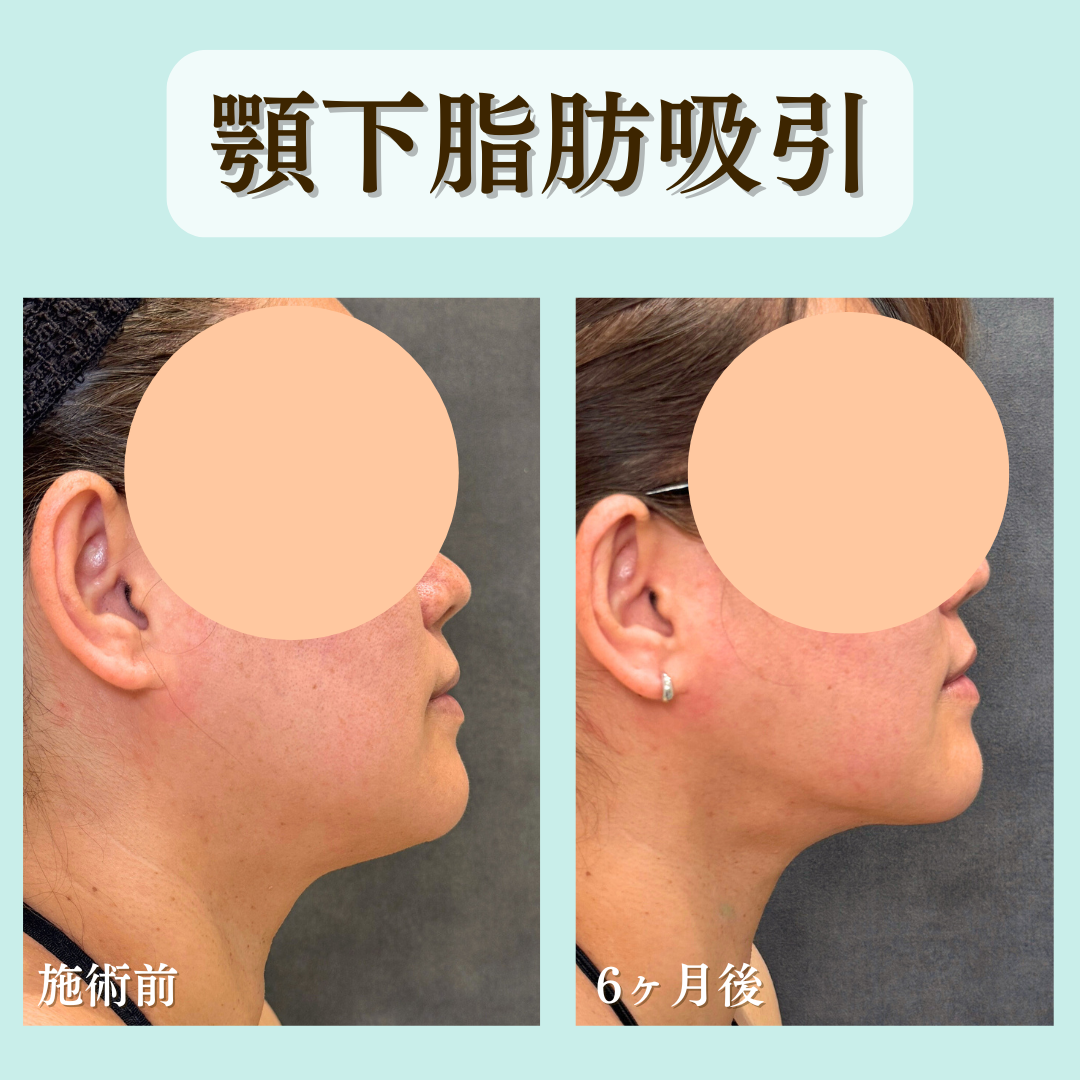 顎下脂肪吸引の症例になります💁
