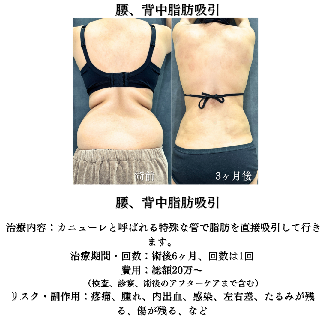 腰とウエスト、背中の脂肪吸引の症例です💁