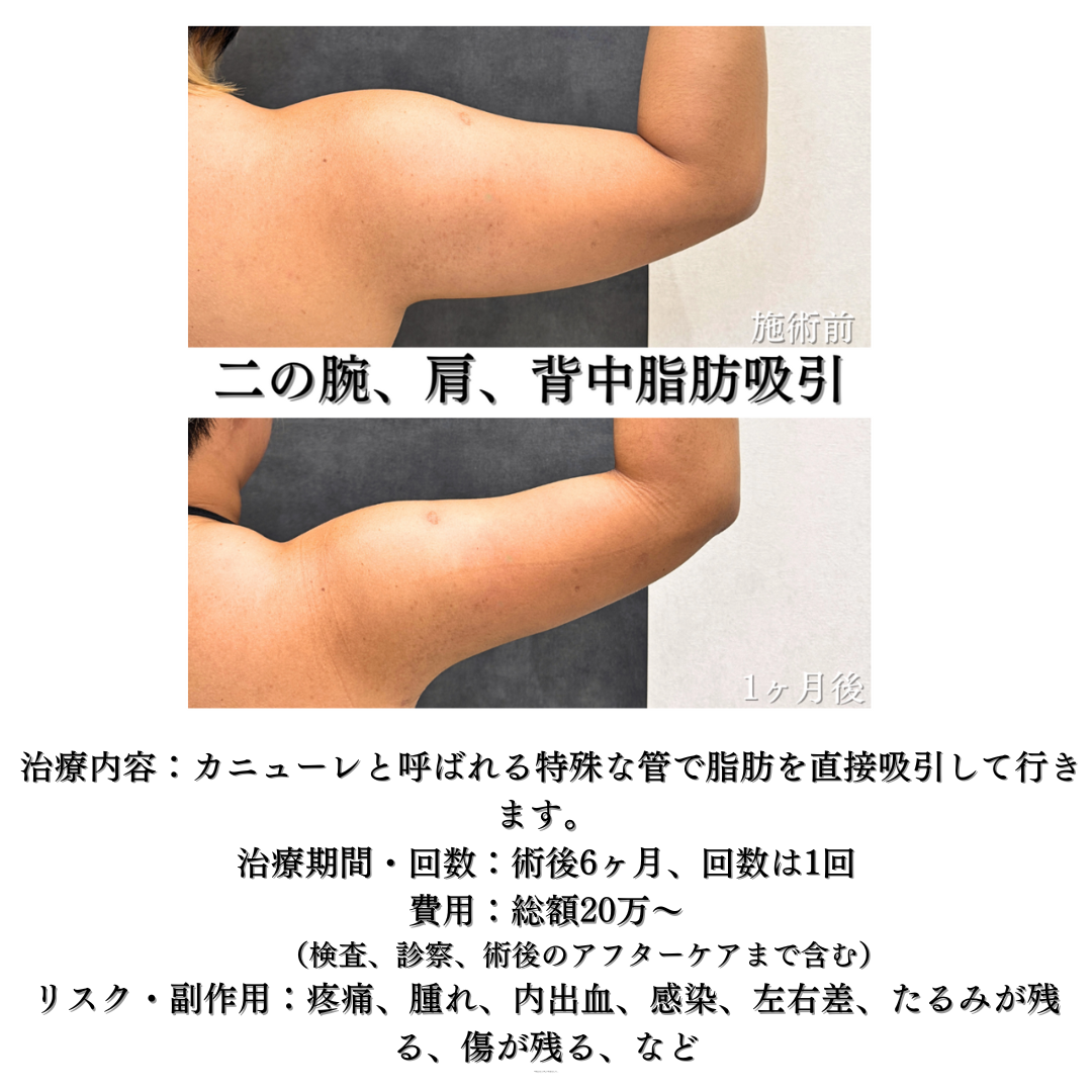 二の腕、肩、背中の脂肪吸引の症例です💡