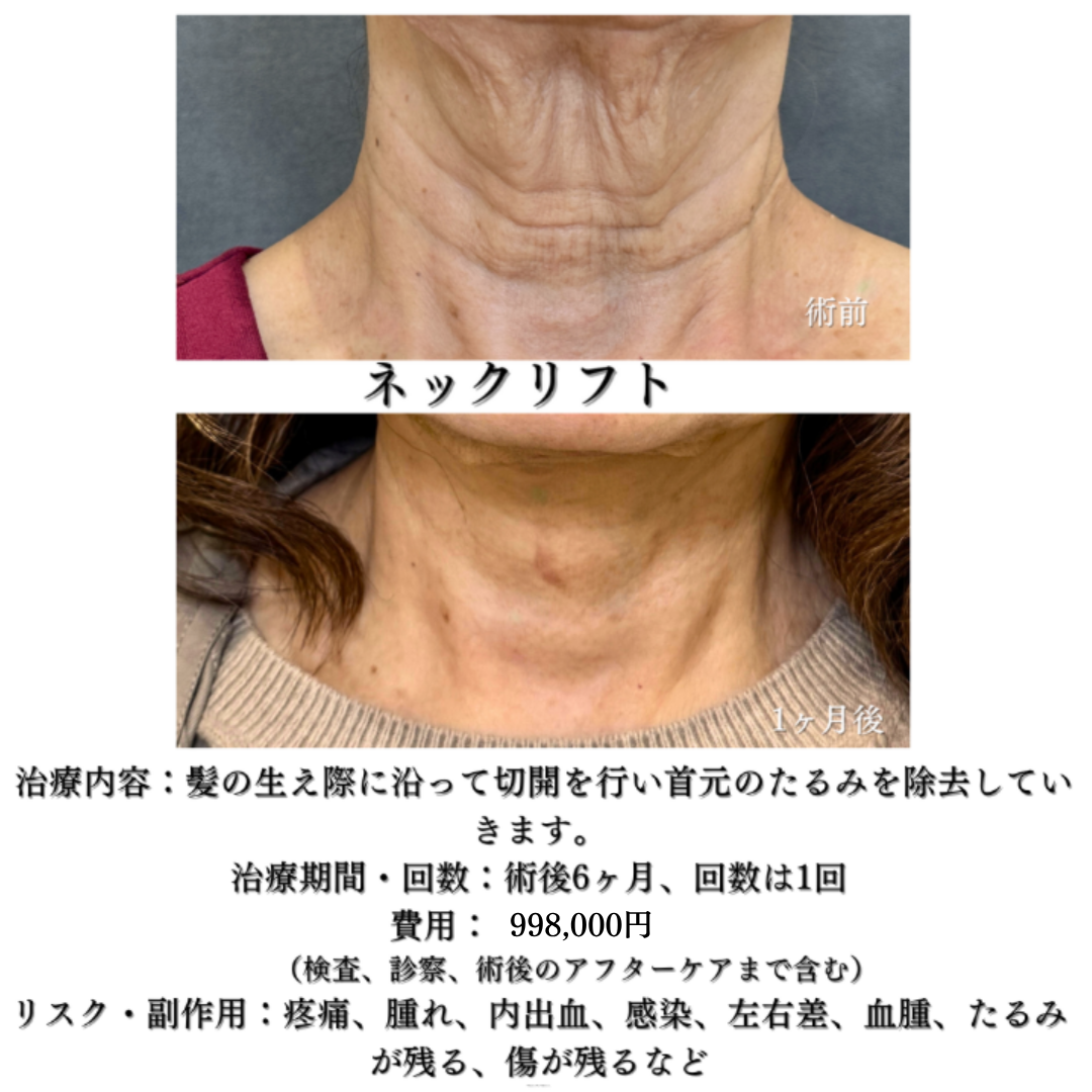 ネックリフトの症例です💁