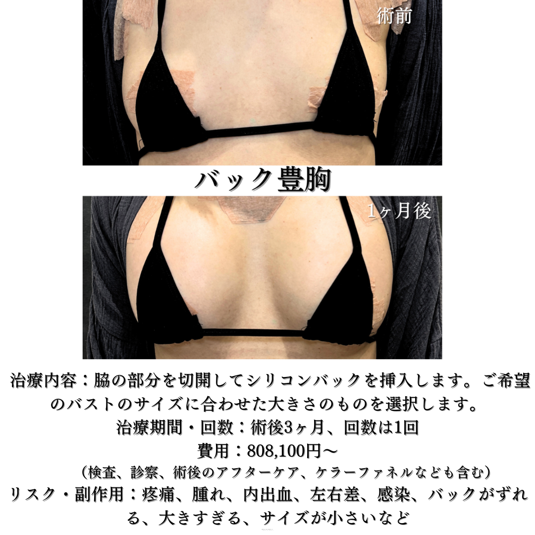 バック豊胸の症例です💡