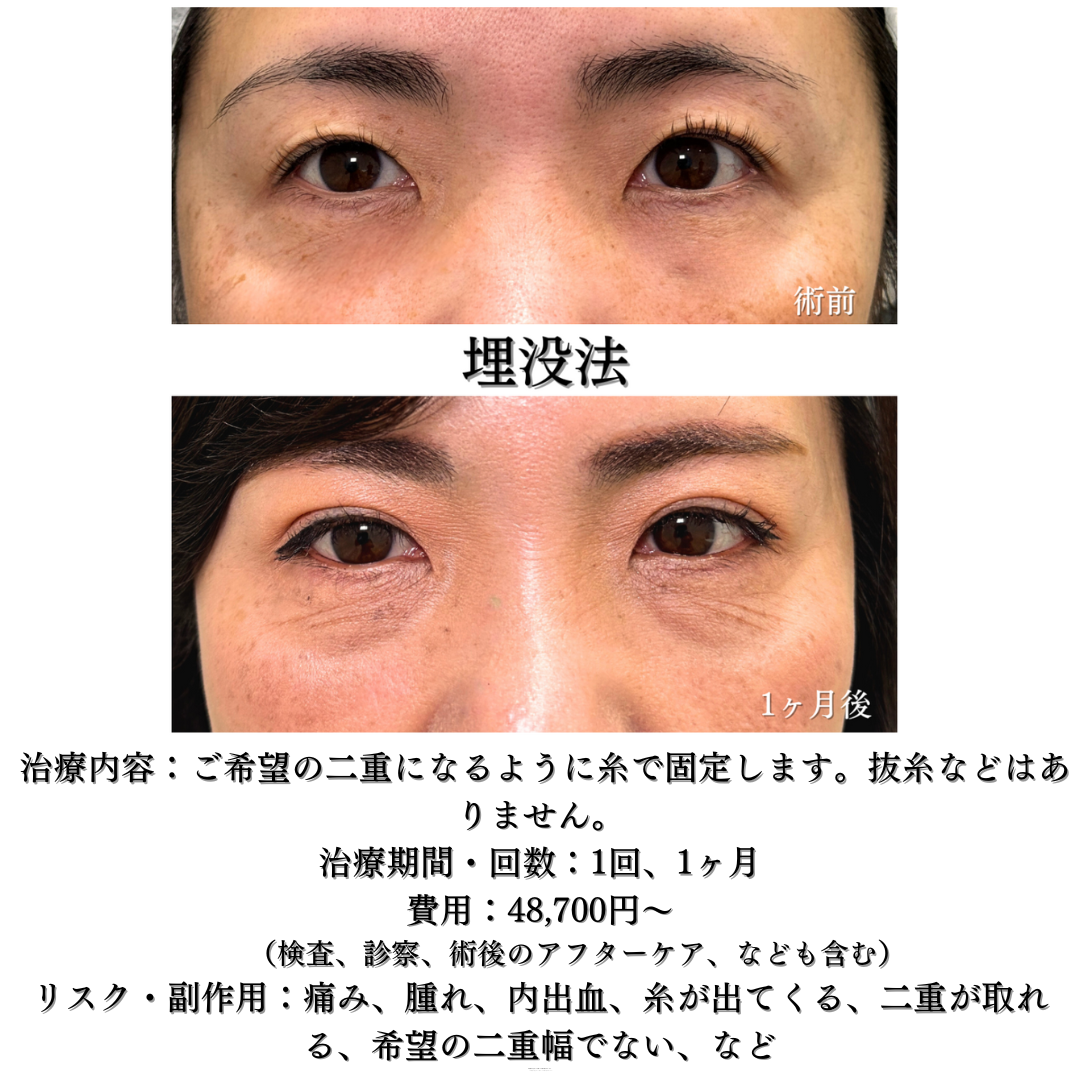 二重埋没法5点どめの症例です💡