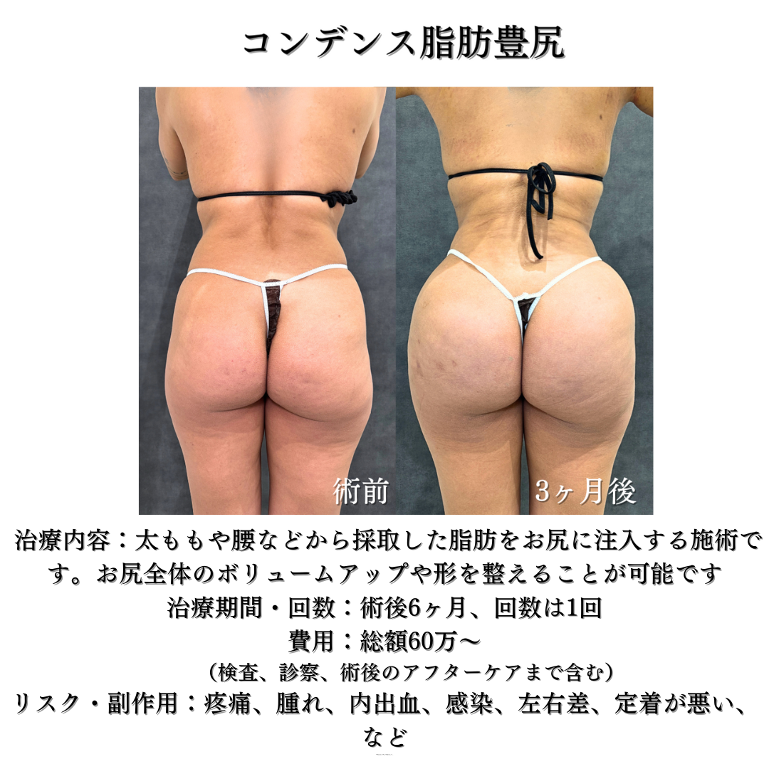 コンデンス脂肪豊尻（BBL）の症例です💡