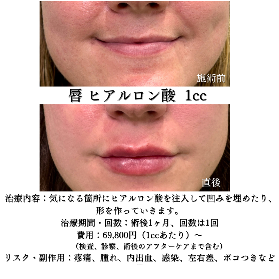 唇ヒアルロン酸（ボリフト1cc）の症例です💁